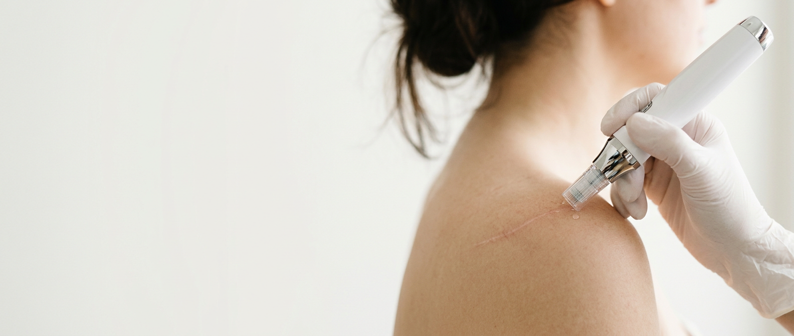 Microneedling-Gerät an einer feinen Narbe an der Schulter einer Frau